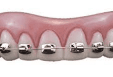 Diş Telleriyle İlgili Çoğumuzun Doğru Sandığı Yanlış Düşünce